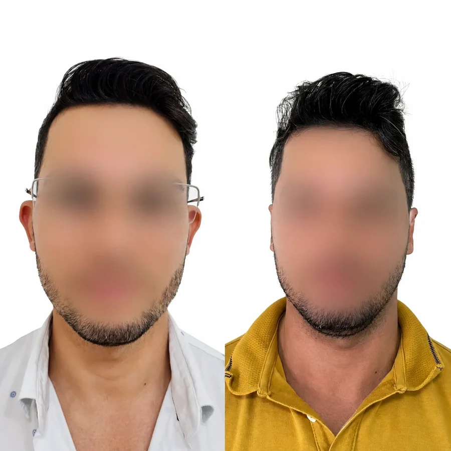 Comparativo de antes e depois de otomodelação — caso 04