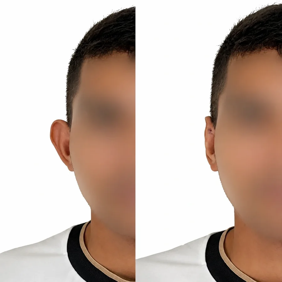 Comparativo de antes e depois de otomodelação — caso 06