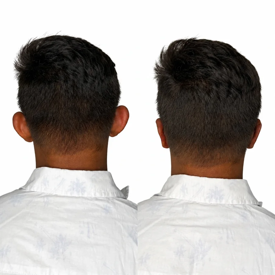 Comparativo de antes e depois de otomodelação — caso 08