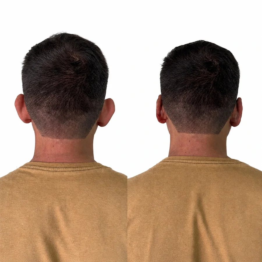 Comparativo de antes e depois de otomodelação — caso 09