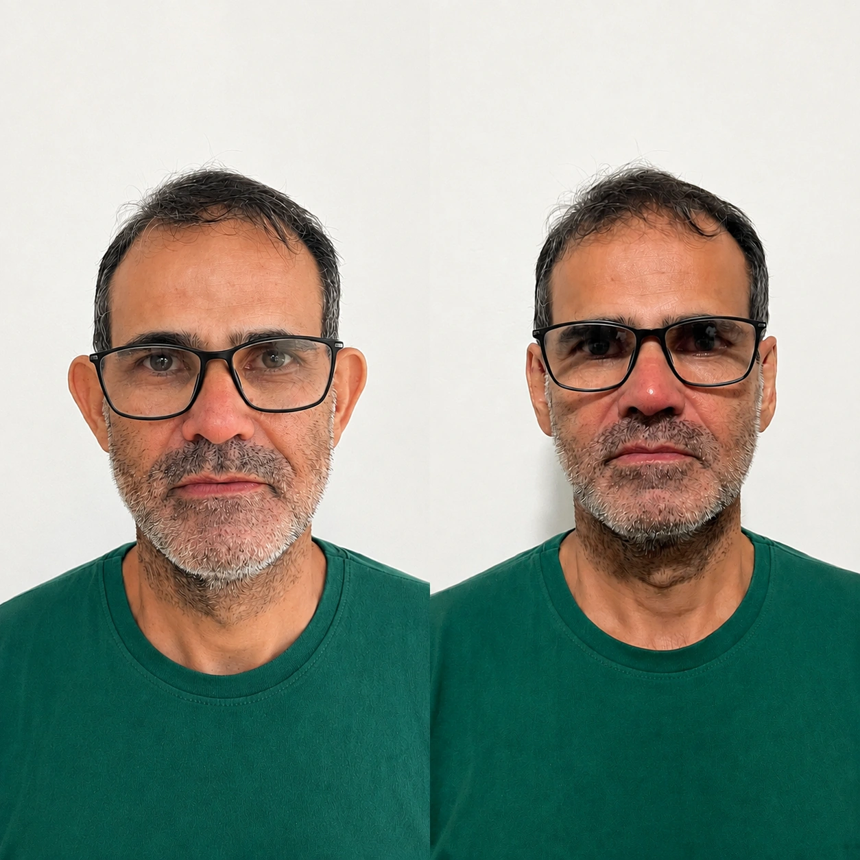 Caso real de otomodelação — antes e depois