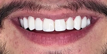 Depois das facetas em resina