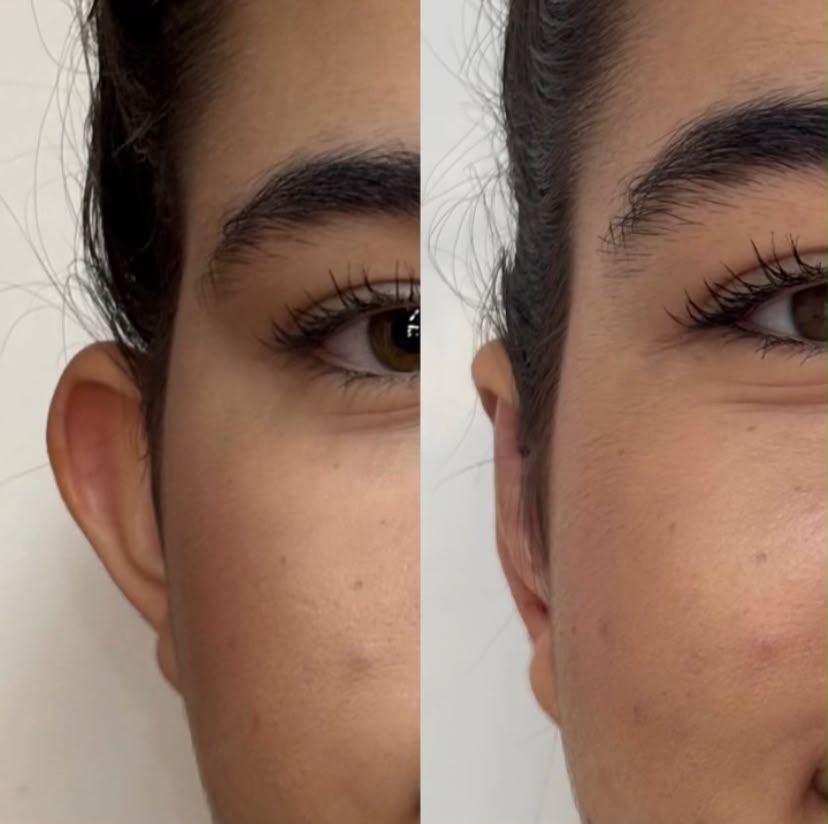 Comparativo de antes e depois de otomodelação — caso 01
